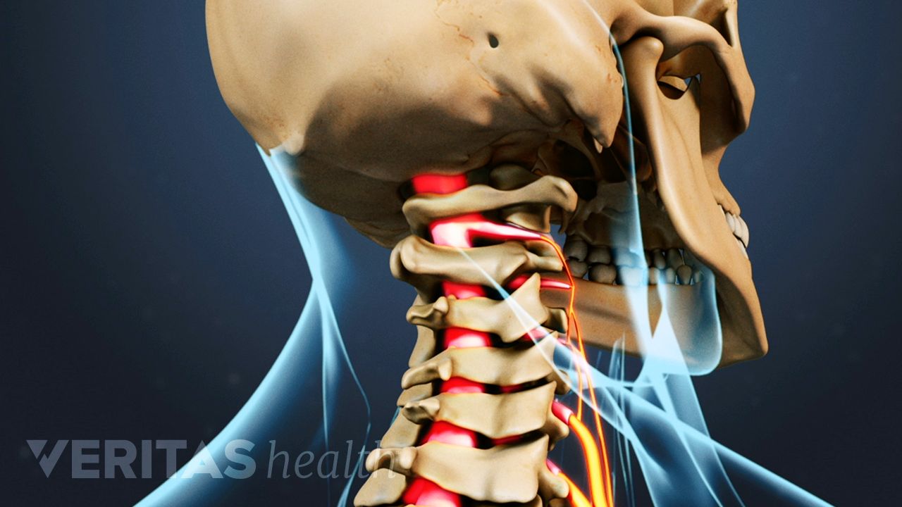 How Cervical Radiculopathy Causes Pain, Numbness, And Weakness