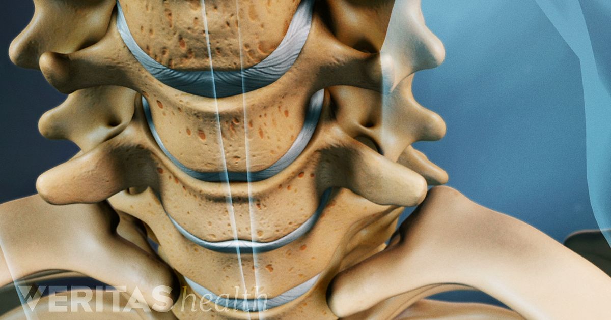 Understanding The Clinical Diagnosis Of A Herniated Disc