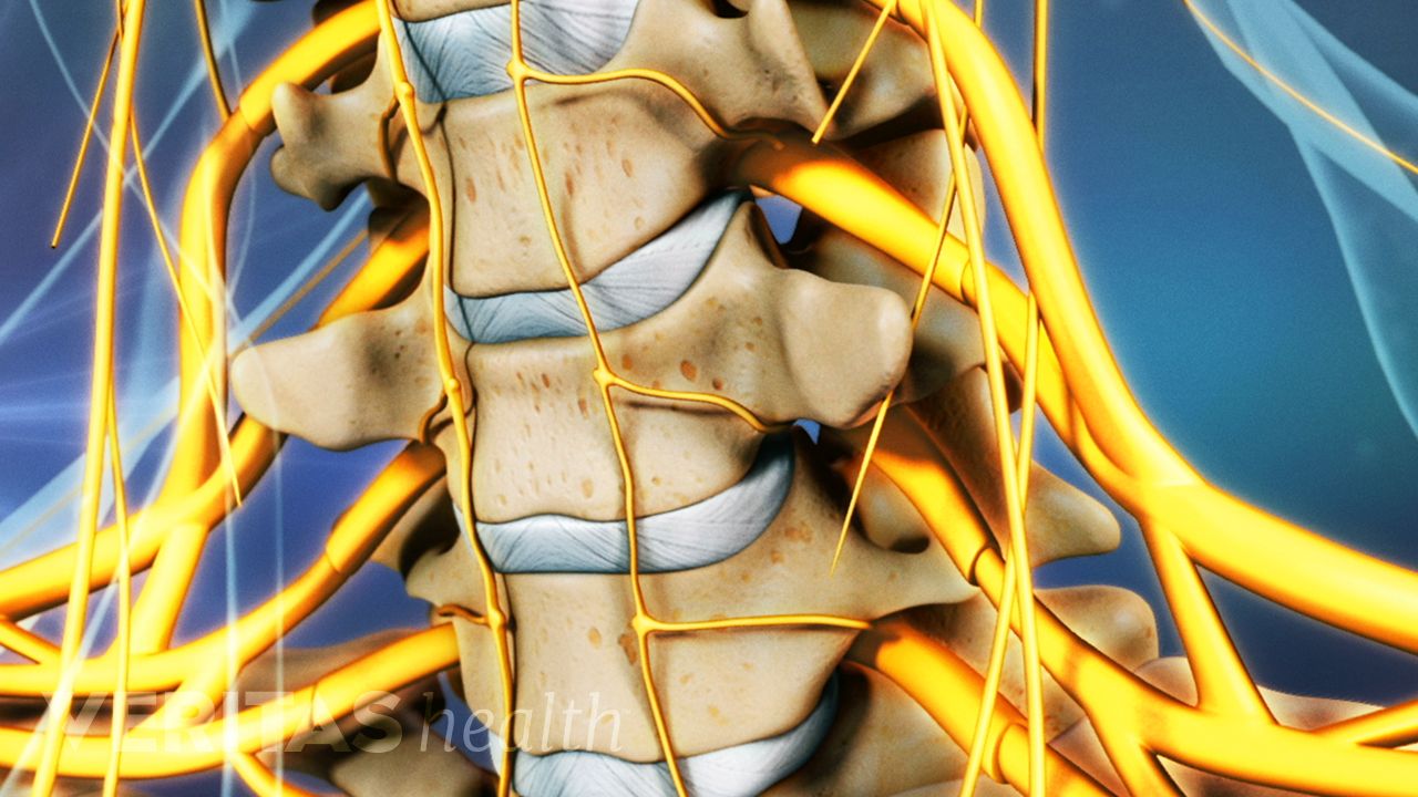 What are the risks of surgery for a herniated disc in the neck?