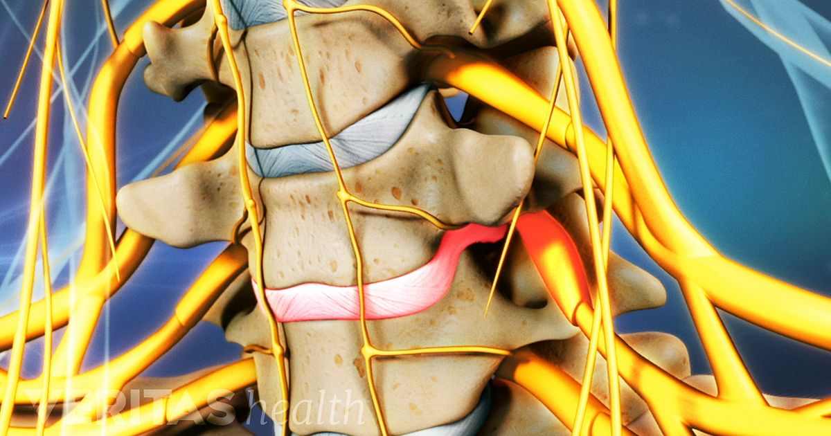 Cervical Herniated Disc Video: Overview Of A Cervical Herniated Disc