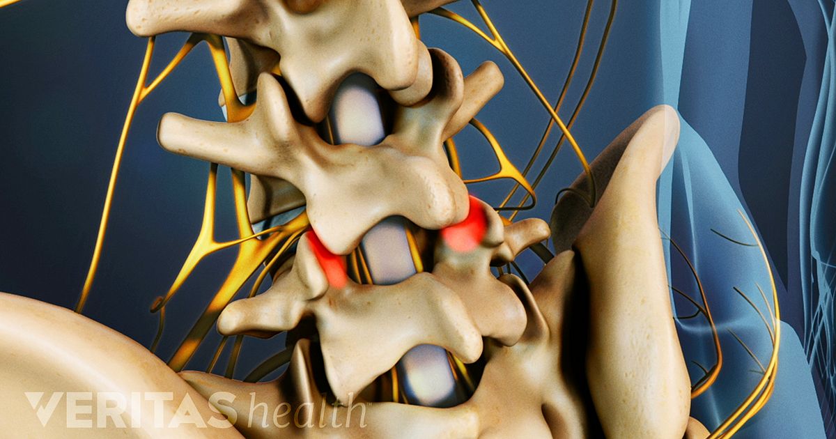 What You Need To Know About Spondylosis