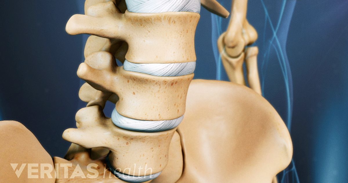 What is degenerative retrolisthesis
