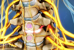 c6 cervical radiculopathy c7 neck spine spinal segment pain