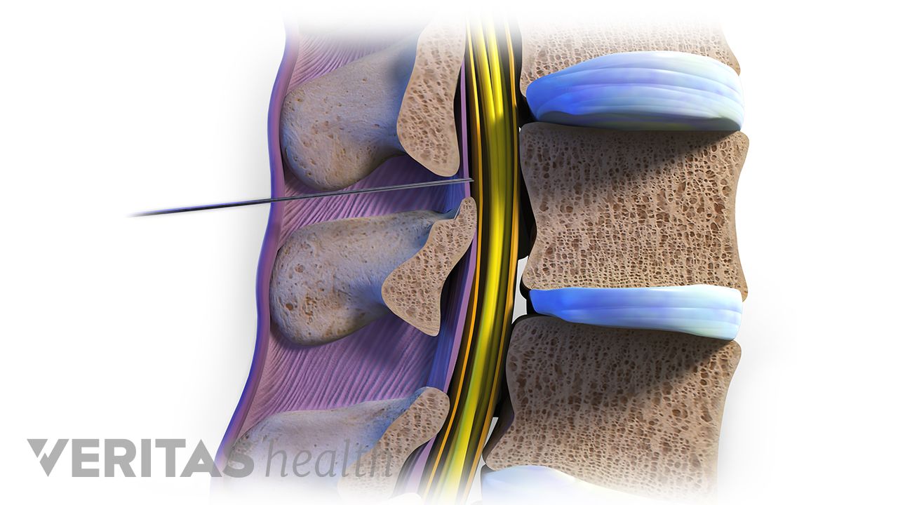 What are the side effects of transforaminal epidural steroid injection?