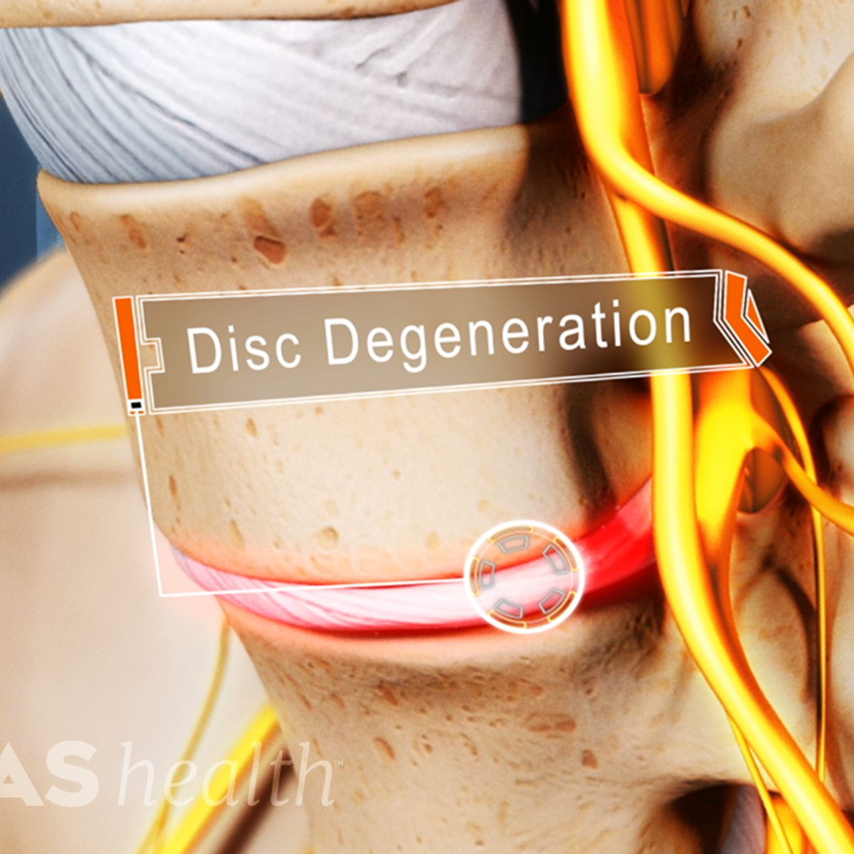 Lumbar Degenerative Disc Disease Overview, Causes, and Symptoms