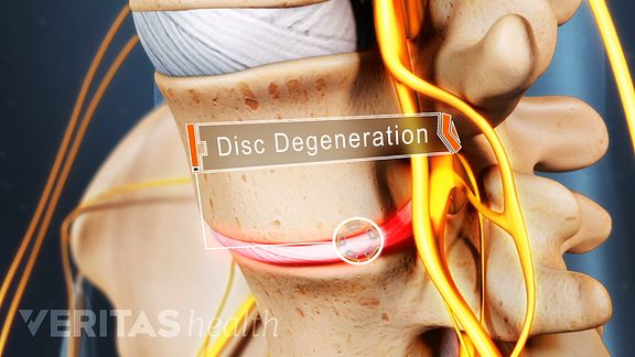 lumbar-degenerative-disc-disease-overview-causes-and-symptoms