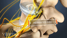 Superior, posterior view of a herniated disc in the lumbar spine.
