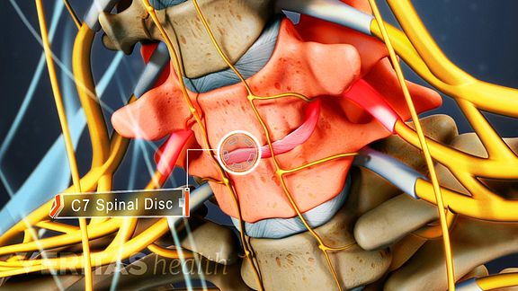 How Cervical Radiculopathy Causes Pain, Numbness, And Weakness