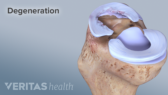 Degenerated Cartilage