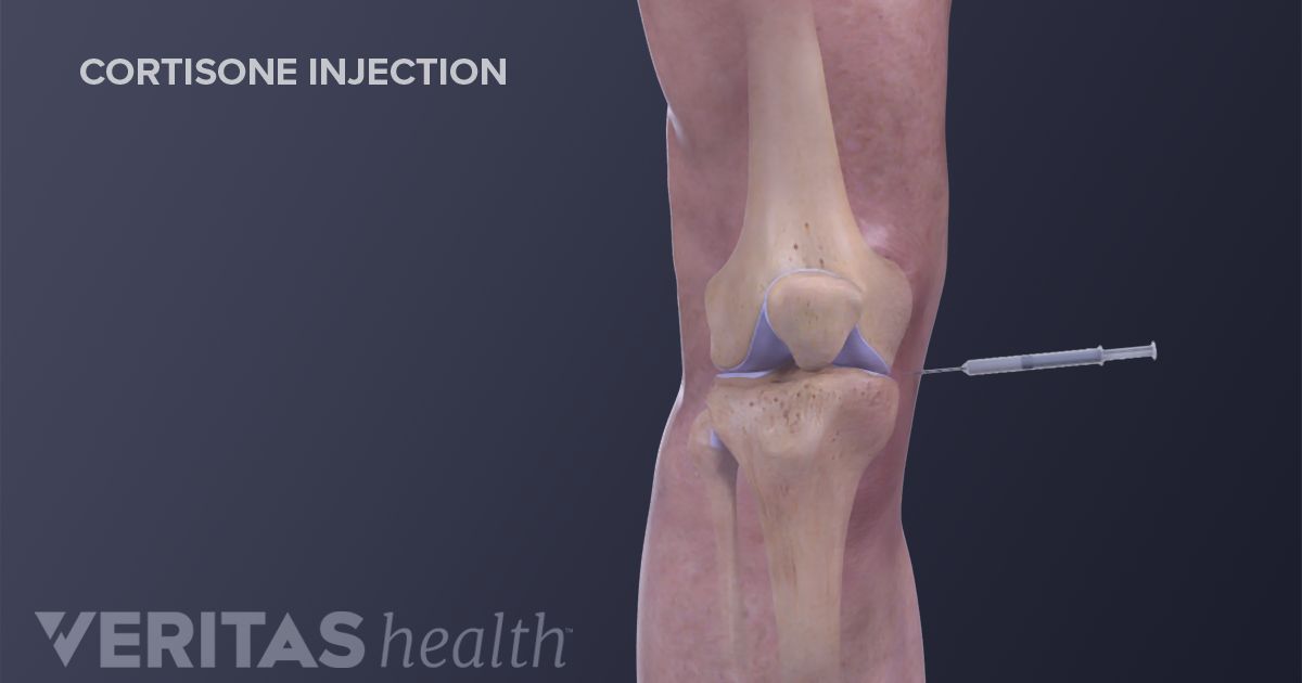 Q&A Why Cortisone Injections Can Be Controversial