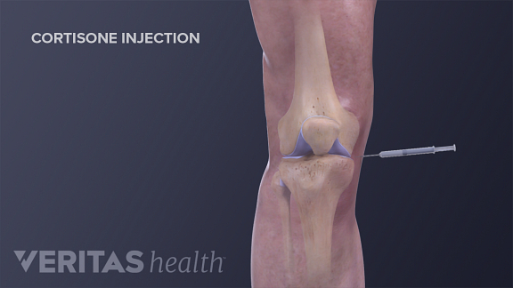 steroid injections in knee technique steroid injections in knee technique