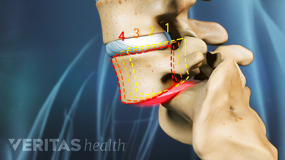 Graad 1 listhesis