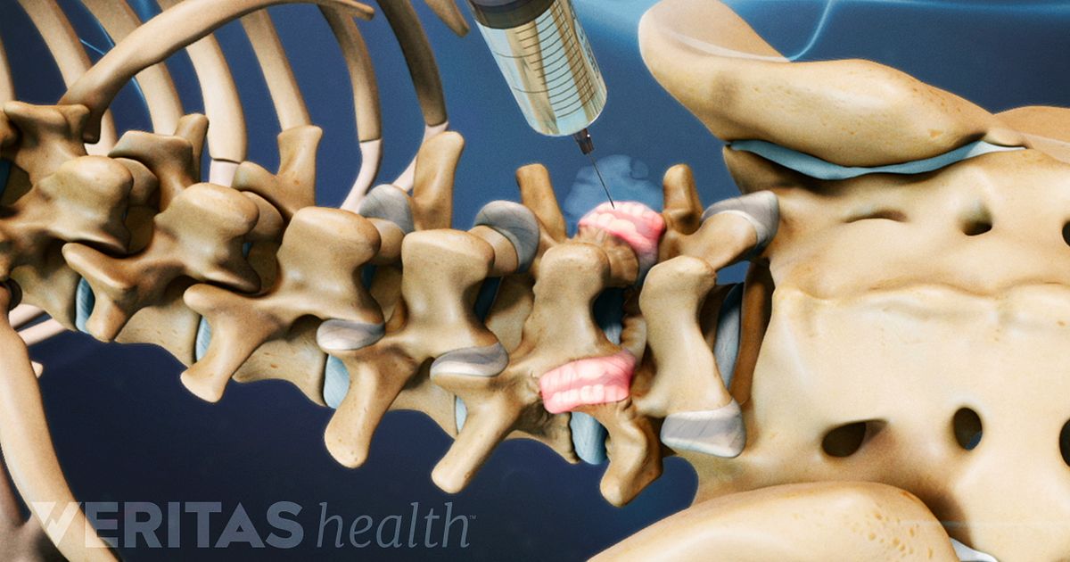 Selective Nerve Root Blocks (SNRB) And Facet Joint Injections