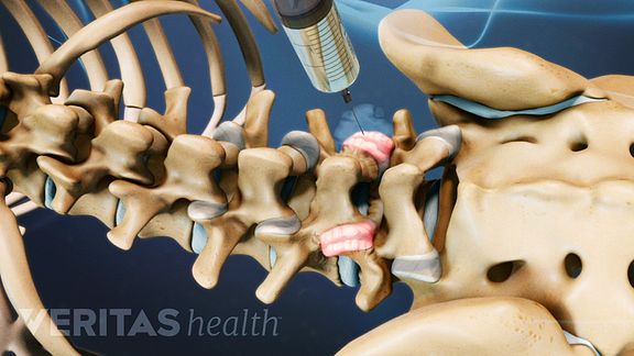 Cervical Thoracic And Lumbar Facet Joint Injections 0298