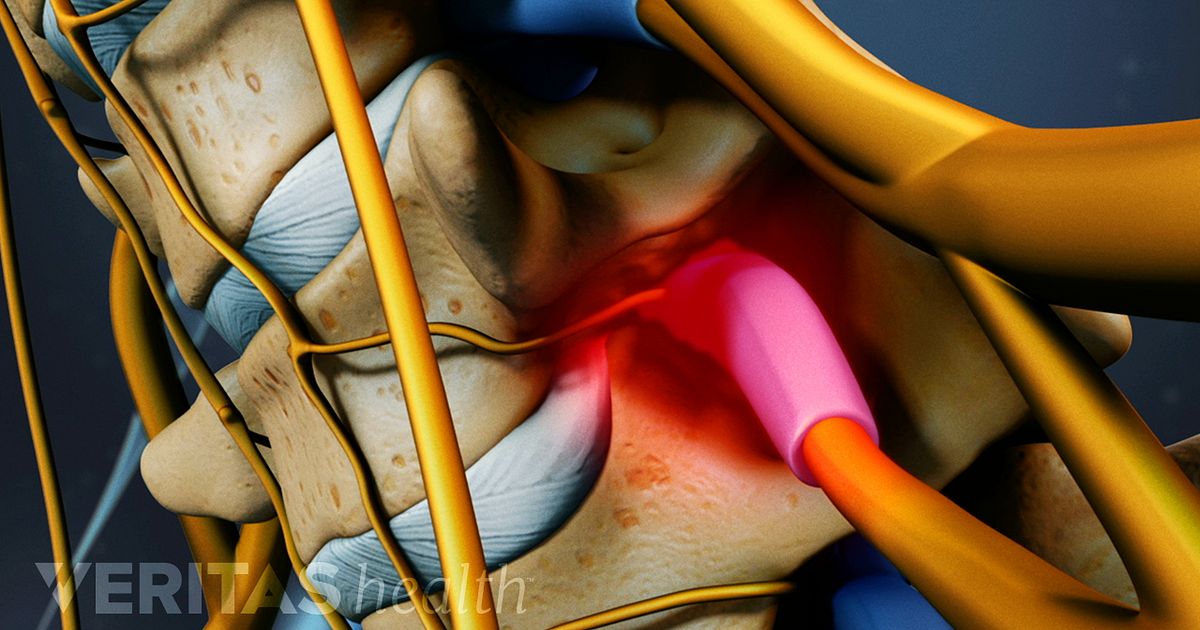 Cervical Radiculopathy from a Herniated Cervical Disc