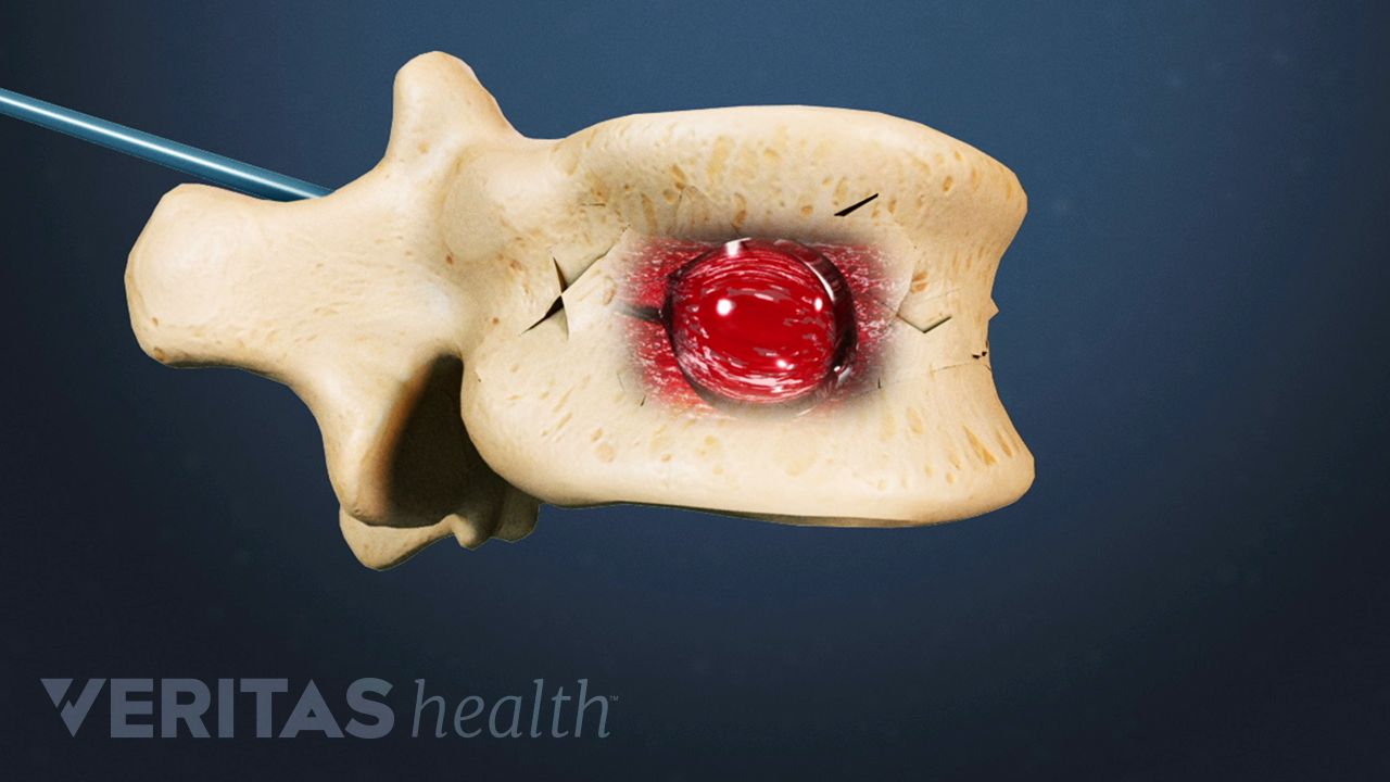 Description of Kyphoplasty Surgery