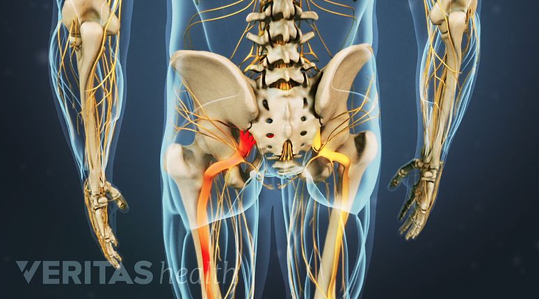 Sciatica: What You Need To Know About Sciatica