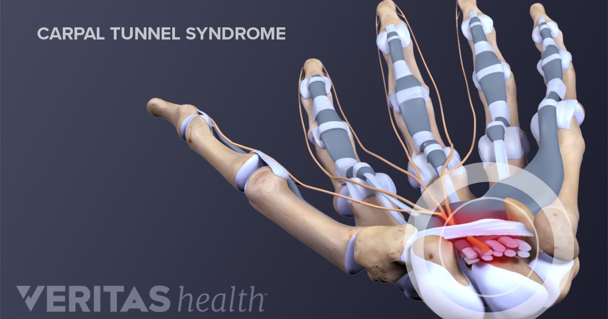 Carpal Tunnel Syndrome