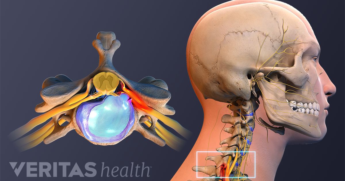 Diagnostic Tests For A Cervical Herniated Disc