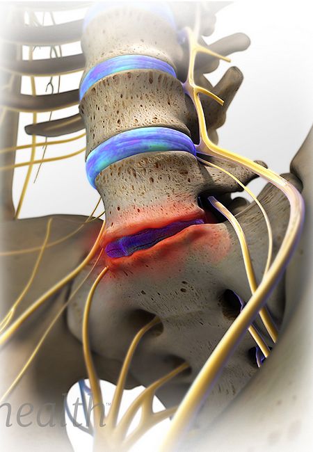 Degenerative Disc Disease Treatment For Low Back Pain degenerative-disc-disease-treatment-for-low-back-pain