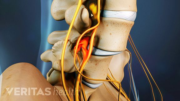 Spondylosis Video