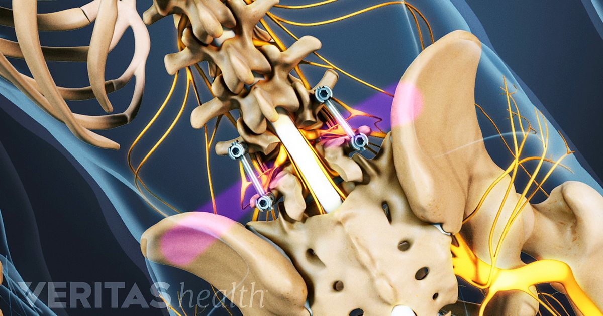 Postoperative Care for Spinal Fusion Surgery