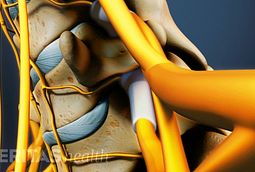 retrolisthesis and emedicine Spondylolisthesis can be a painful condition affecting the back caused by a vertebrae from the lower spine slipping out of position. retrolisthesis and emedicine Spondylolisthesis can be a painful condition affecting the back caused by a vertebrae from the lower spine slipping out of position.