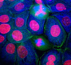 micro_path_breast_cancer_0001.jpg