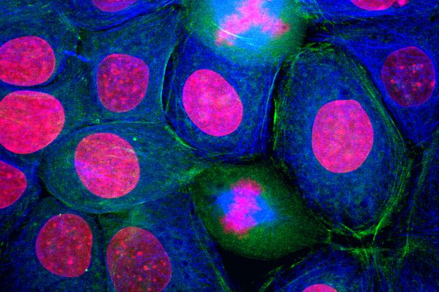 microscopic image of breast cancer cells.jpg