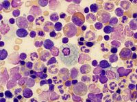 Clinical sample analysis and clinical biomarker analysis services supports the decision to progress your oncology drug.