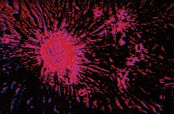 micro electron image of breast cancer cells.