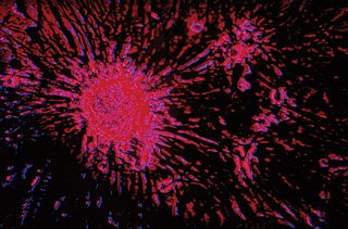Microscopic image of breast cancer