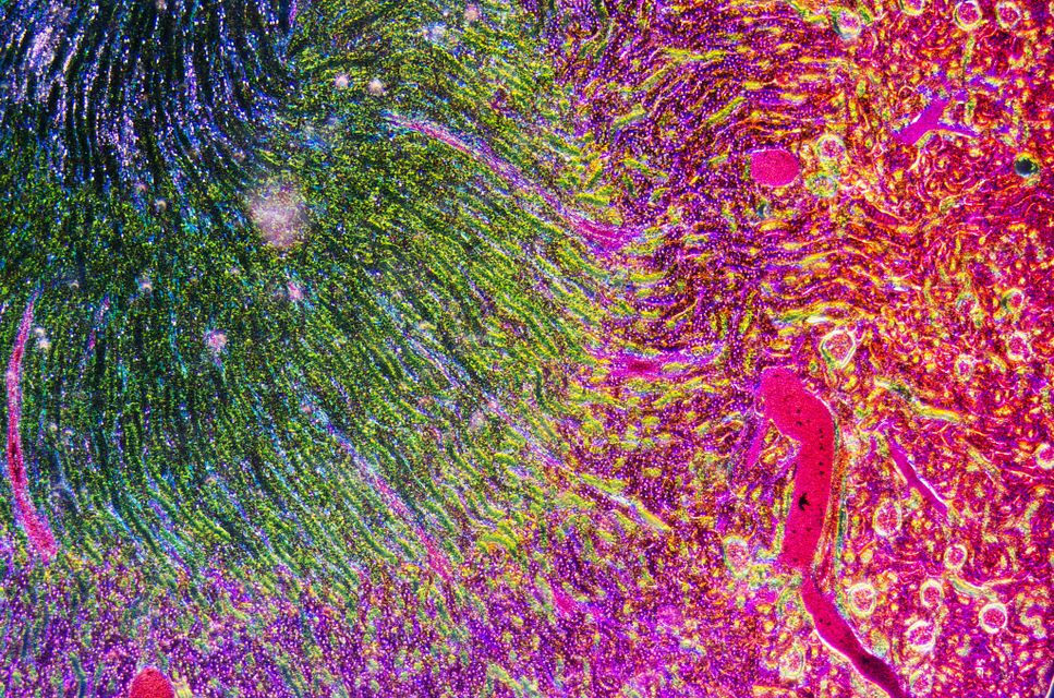 Image of a kidney representing the damage caused by nephritis. Nephritis is an immune complex-mediated autoimmune disease characterized by kidney inflammation. Nephritis is clinically diagnosed through urine tests, blood tests, and kidney biopsies. Charles River has characterized a nephrotoxic nephritis mouse model induced by administration of nephrotoxic antiserum (NTS).