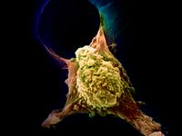 Metastasis of cancerous cell.