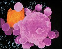 Image of cancer cells under a micro electron microscope.