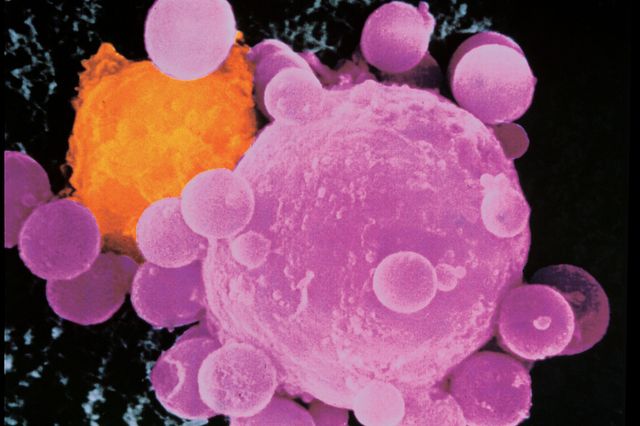 pink and orange micro electron image of a cancer cell