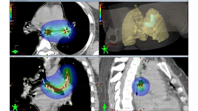 BrachyVision treatment planning system