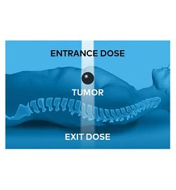 Conventional radiotherapy deposits most of the dose at the entrance and travels past the tumor
