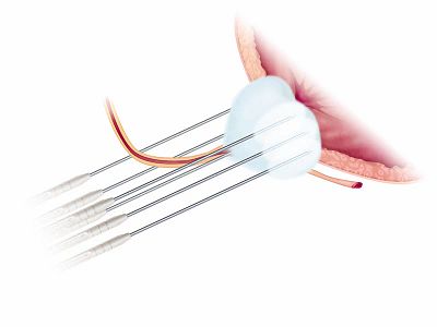 V-PROBES placed at the lateral edges of the gland