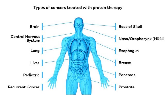 Benefits Of Intensity Modulated Proton Therapy | Varian