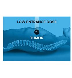 Proton therapy deposits most of the dose in the tumor with minimal entrance and no exit dose