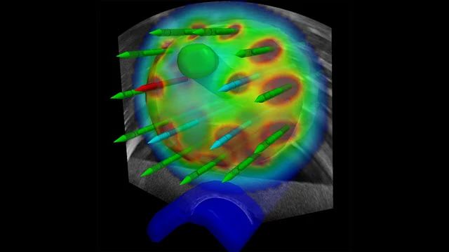 Ultrasound-based Brachy Planning