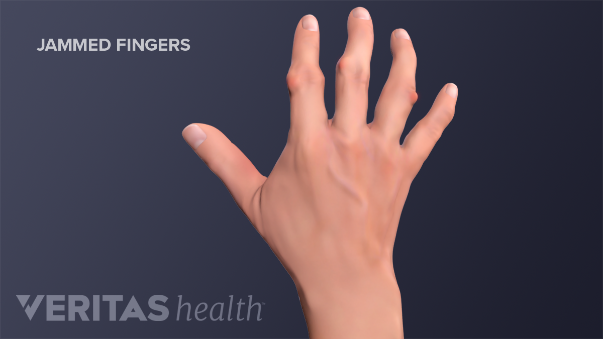 Heartwarming Tips About How To Heal Jammed Finger - Effectsteak33