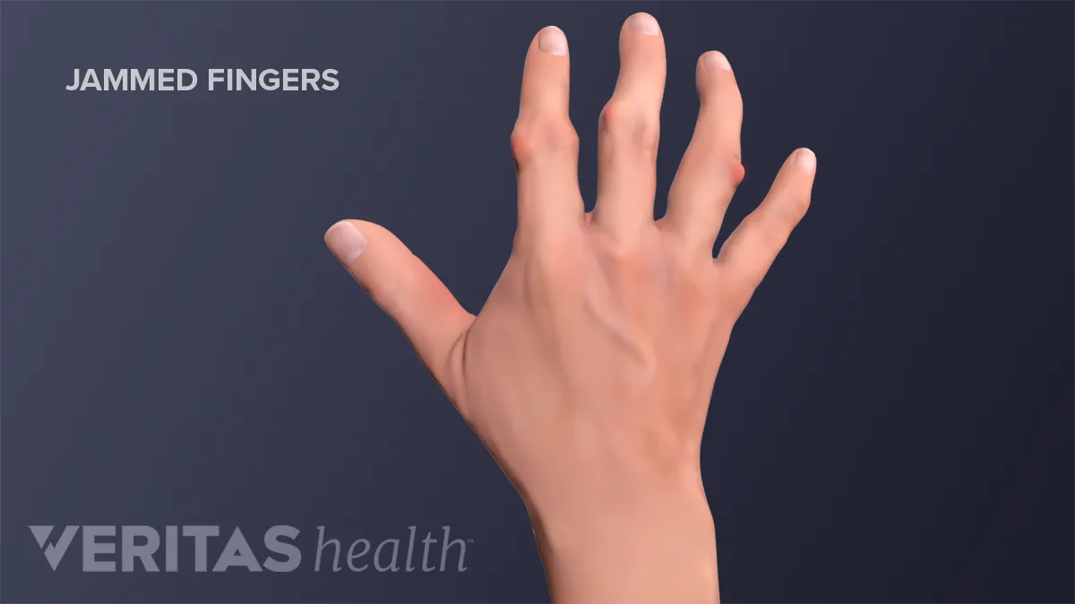 Treatment of jammed finger depends on severity | Features | thederrick.com