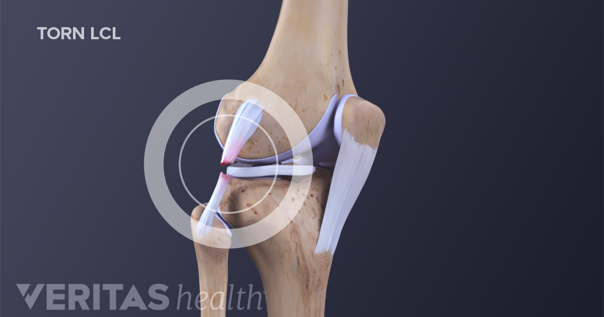 What Does A Mcl Sprain Look Like