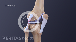 Profile view of a torn LCL in the knee joint.