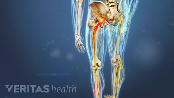 lumbar herniated disc nerve pain