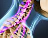 Neck Strains and Sprains Video