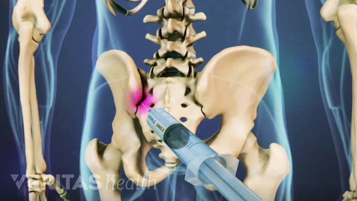 Sacroiliac Joint Dysfunction Symptoms and Treatment Options – Caring  Medical Florida