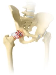 Hip-Arthritic